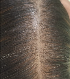 Scalp at first visit