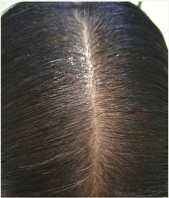 Scalp after four sessions