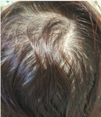 Scalp at first visit