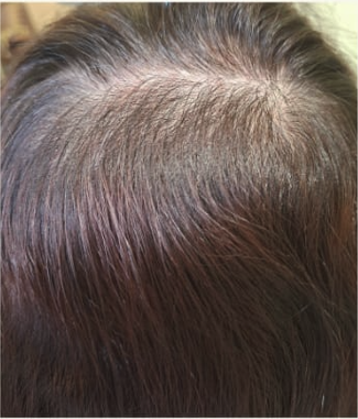 Scalp after four sessions