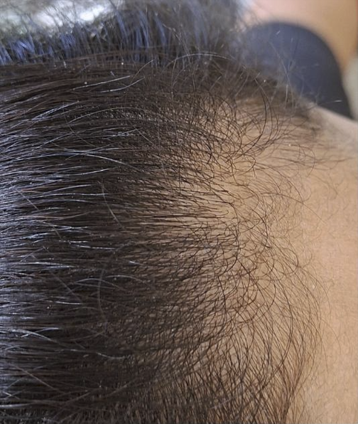 Scalp at first visit