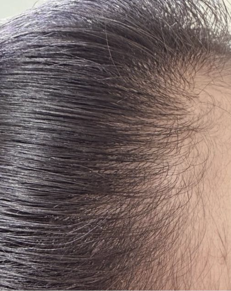 Scalp after six sessions