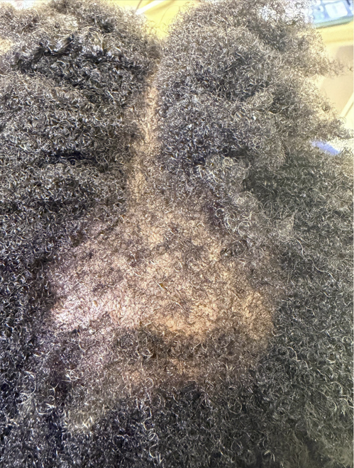 Scalp at first visit